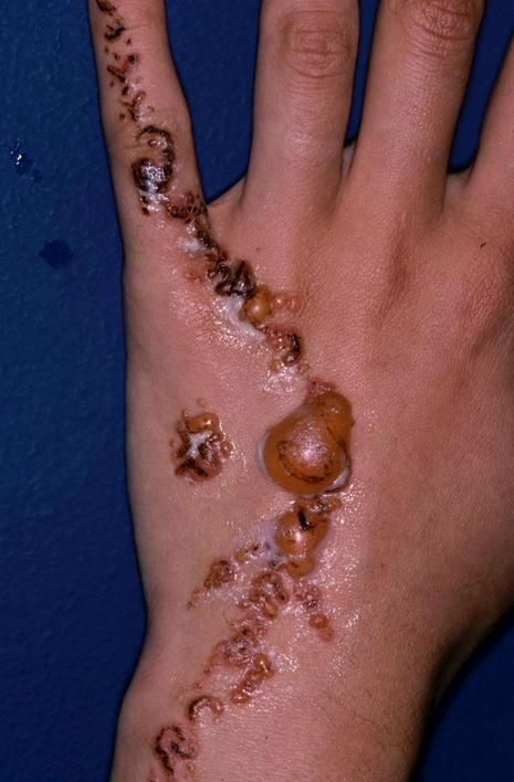 on voit ici une alergie au henn, le dessin apparait en relief sur la main en plaque d'eczema et de pus